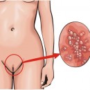 Pustules vaginales : facteurs de risque
