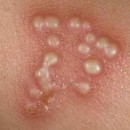 Cloques sur le vagin : Causes