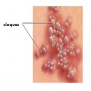Pustules vaginales : Prévention