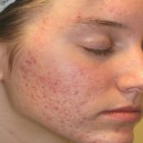 Cicatrices : causes, symptômes, solutions