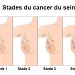 Stades du cancer du sein