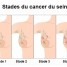 Stades du cancer du sein