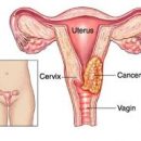 Cancer du col de l’utérus – diagnostic et traitement
