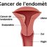 Cancer endométrial – diagnostic et traitement