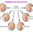 Cancer du sein : Symptômes