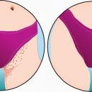 Boutons de bikini