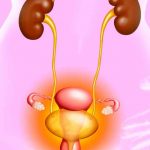 Infections urinaires récurrentes